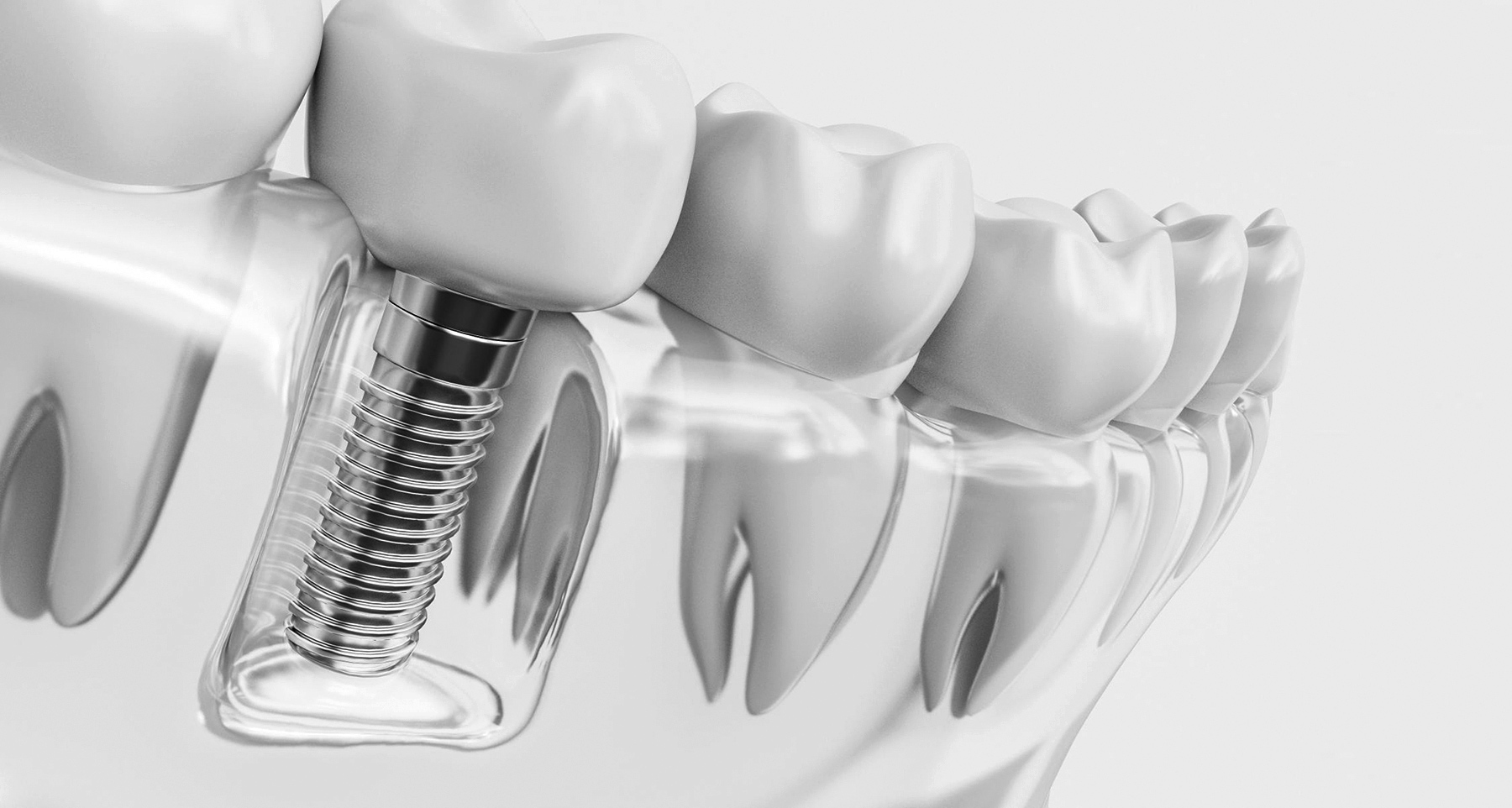 dr berart tratamientos implantes dentales