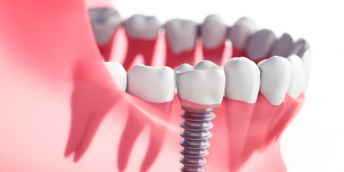 3 meses de tratamiento de implantes dentales