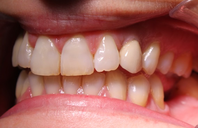 3 meses de tratamiento de implantes dentales