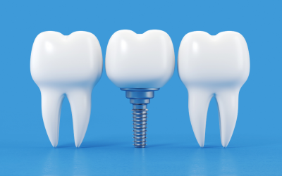 Beneficios de los implantes dentales