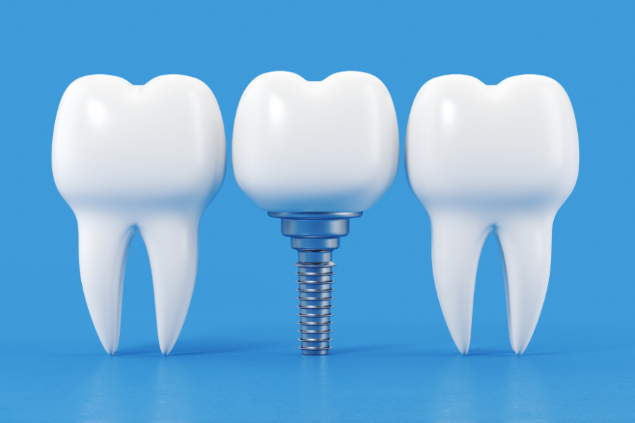 Beneficios de los implantes dentales