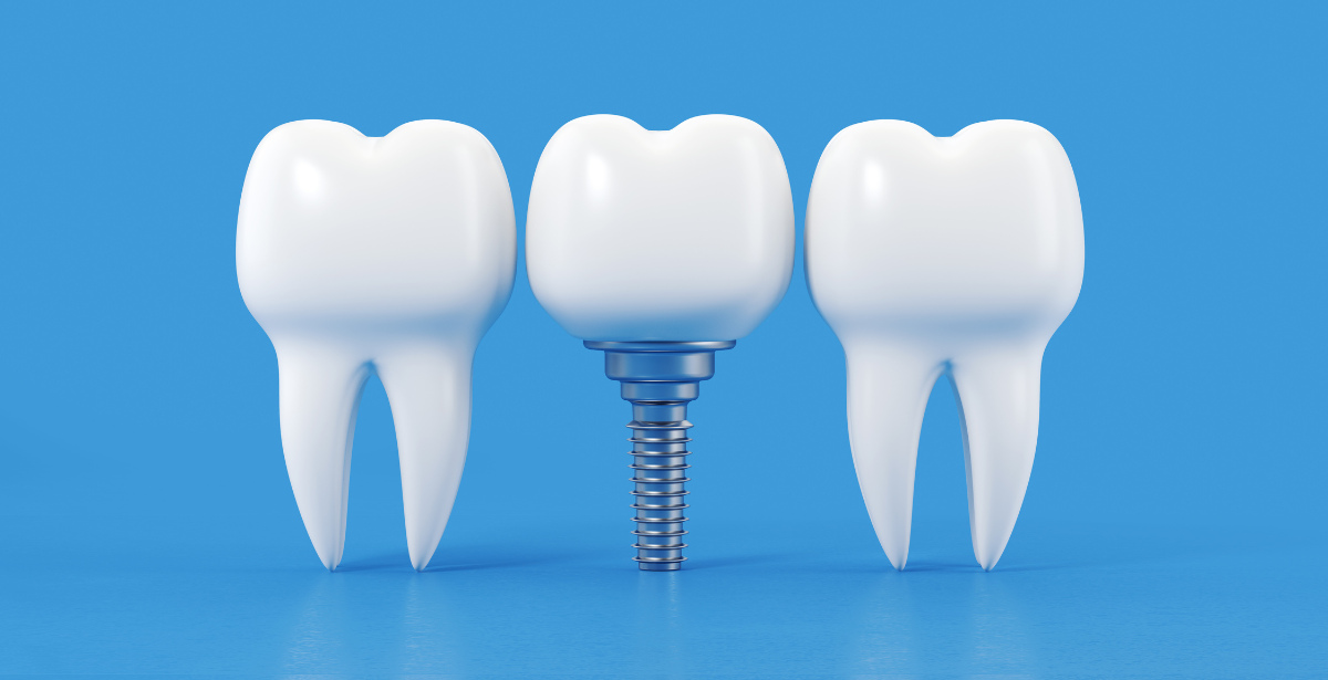 Beneficios de los implantes dentales